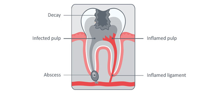 Understanding Tooth Decay