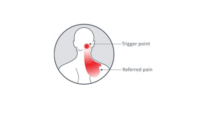 Source of Common Headache Pain